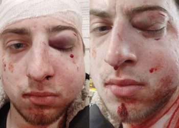 Множинні переломи кісток обличчя: журналіста OBOZREVATEL жорстоко побили в Києві