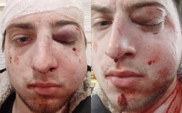 Множинні переломи кісток обличчя: журналіста OBOZREVATEL жорстоко побили в Києві