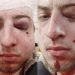 Множинні переломи кісток обличчя: журналіста OBOZREVATEL жорстоко побили в Києві