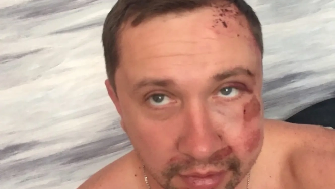 «Нападники діяли за вказівкою»: у Житомирі побили видавця газети, яка відома резонансними публікаціями (оновлено)
